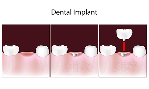 Dental Implants in Flushing