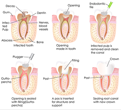 Root Canal Therapy in Bayside