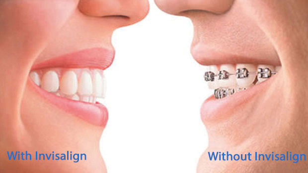 Invisalign in Bayside