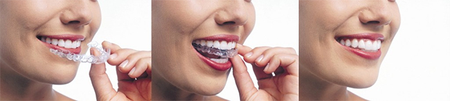 Flushing Invisalign